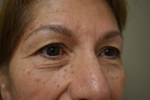 Eyelid Surgery Before & After Gallery - Patient 174223 - Image 2