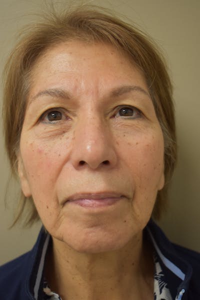 Eyelid Surgery Before & After Gallery - Patient 174223 - Image 1