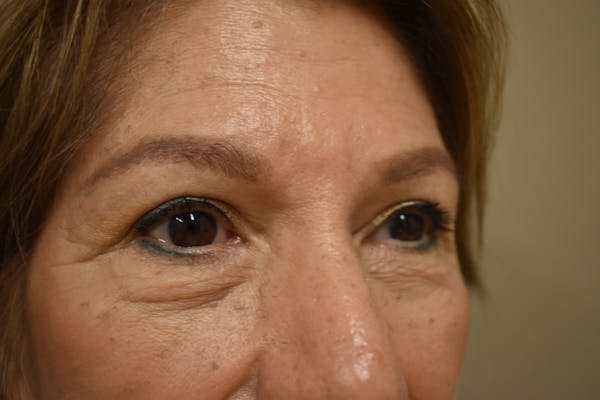 Eyelid Surgery Before & After Gallery - Patient 174223 - Image 4