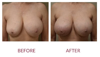 Breast Reconstruction Before & After Gallery - Patient 192417 - Image 1