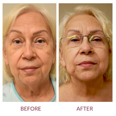 Facelift Before & After Gallery - Patient 343093 - Image 1