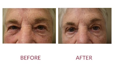 Eyelid Surgery Before & After Gallery - Patient 423735 - Image 1