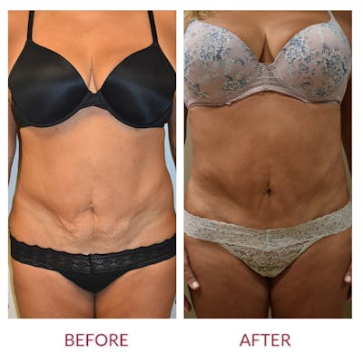 Tummy Tuck Before & After Gallery - Patient 249800 - Image 1