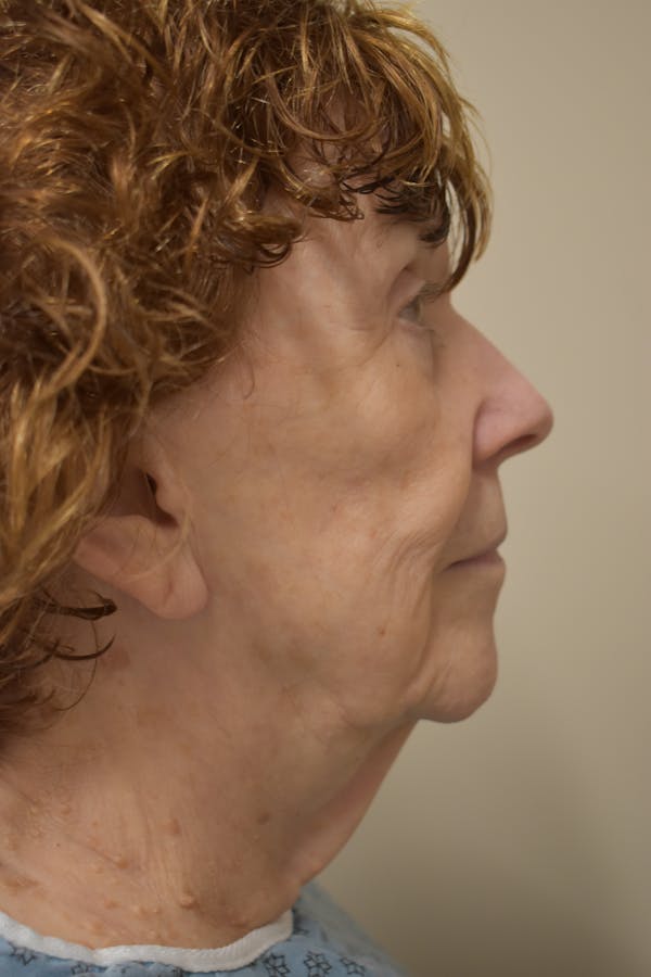Facelift Before & After Gallery - Patient 177588 - Image 3