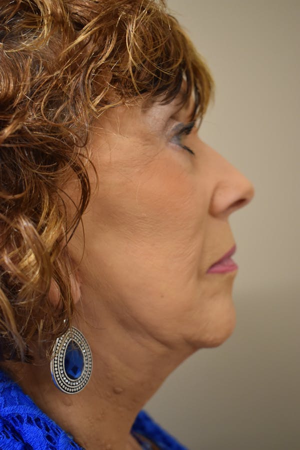 Facelift Before & After Gallery - Patient 177588 - Image 4