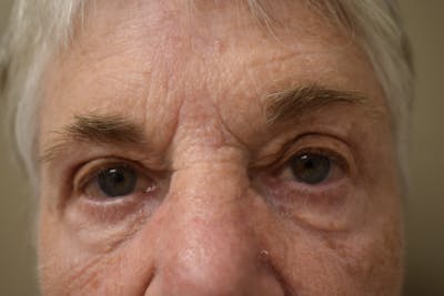 Eyelid Surgery Before & After Gallery - Patient 251267 - Image 1