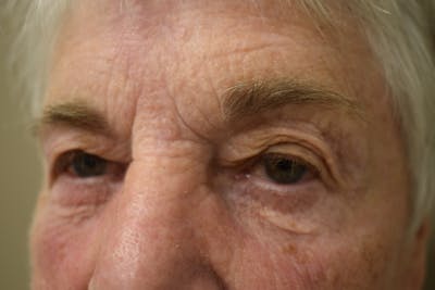 Eyelid Surgery Before & After Gallery - Patient 251267 - Image 2