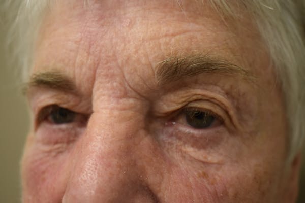 Eyelid Surgery Before & After Gallery - Patient 251267 - Image 2