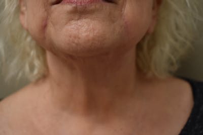 Facelift Before & After Gallery - Patient 136991 - Image 1