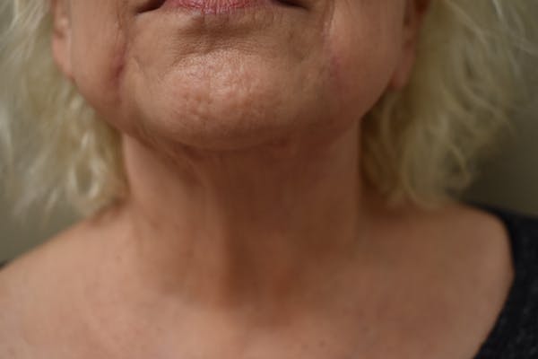 Facelift Before & After Gallery - Patient 136991 - Image 1