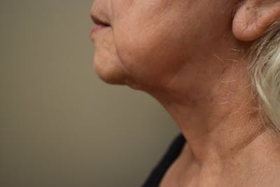 Chin Tuck Before & After Gallery - Patient 293111 - Image 4