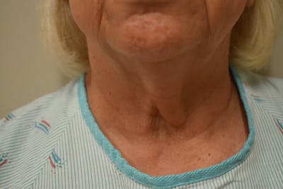 Facelift Before & After Gallery - Patient 136991 - Image 4