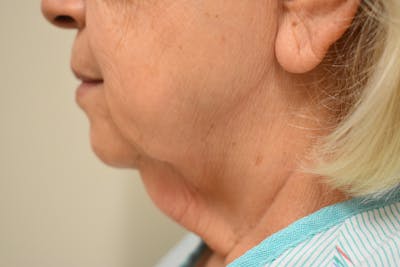 Facelift Before & After Gallery - Patient 136991 - Image 2