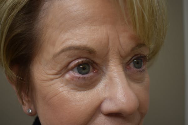 Eyelid Surgery Before & After Gallery - Patient 345817 - Image 1