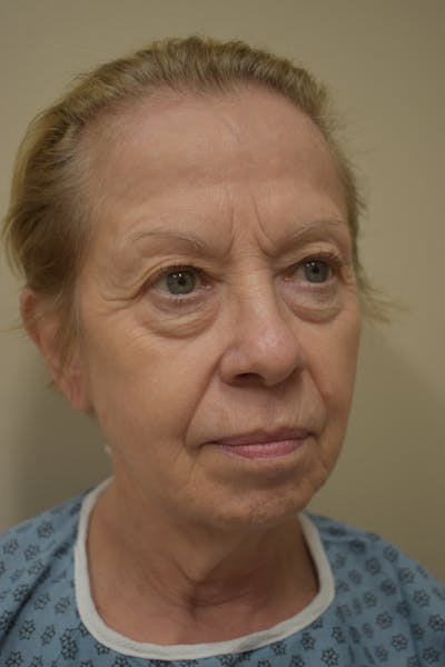 Facelift Before & After Gallery - Patient 377639 - Image 1