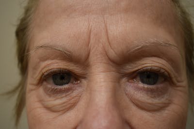 Eyelid Surgery Before & After Gallery - Patient 345817 - Image 2