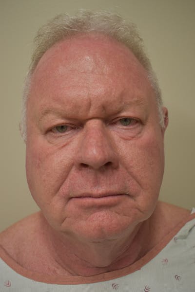 Eyelid Surgery Before & After Gallery - Patient 665023 - Image 1