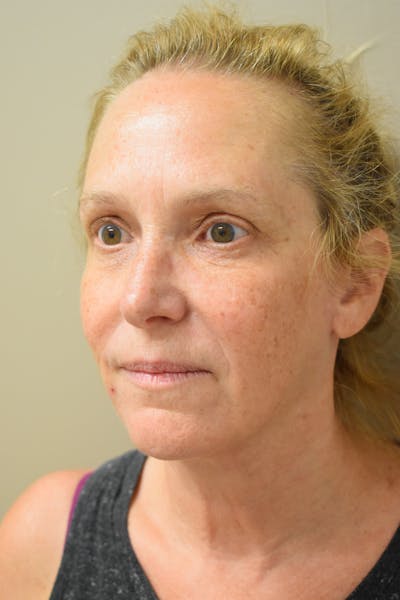 Facelift Before & After Gallery - Patient 261610 - Image 2