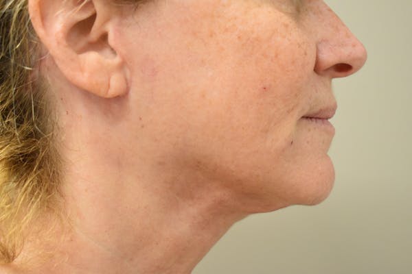 Facelift Before & After Gallery - Patient 261610 - Image 4