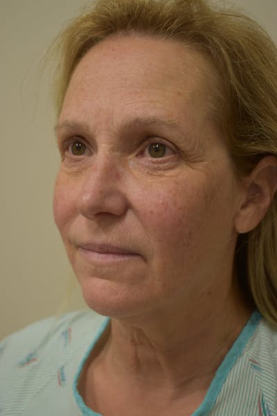 Facelift Before & After Gallery - Patient 261610 - Image 1