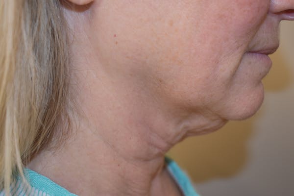 Facelift Before & After Gallery - Patient 261610 - Image 3