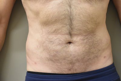 Liposuction Before & After Gallery - Patient 101305 - Image 2