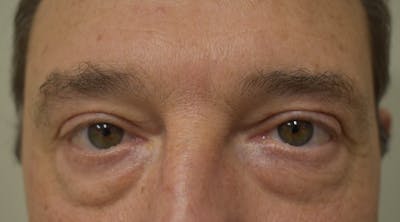 Eyelid Surgery Before & After Gallery - Patient 304891 - Image 1