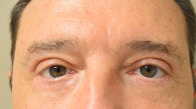 Eyelid Surgery Before & After Gallery - Patient 304891 - Image 2