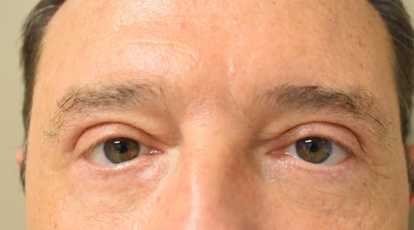Eyelid Surgery Before & After Gallery - Patient 304891 - Image 2