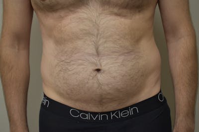 Liposuction Before & After Gallery - Patient 101305 - Image 1