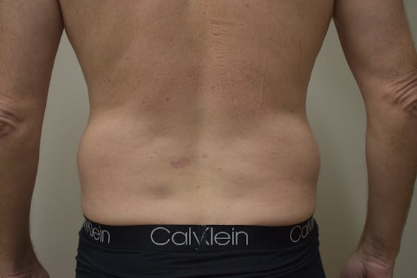 Liposuction Before & After Gallery - Patient 101305 - Image 3