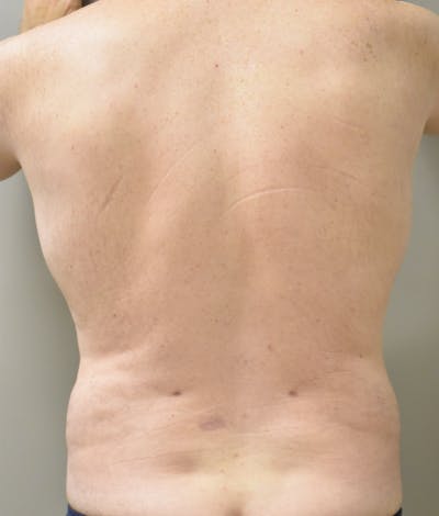 Liposuction Before & After Gallery - Patient 101305 - Image 4
