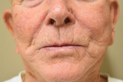 Nasolabial Fold Before & After Gallery - Patient 211689 - Image 4