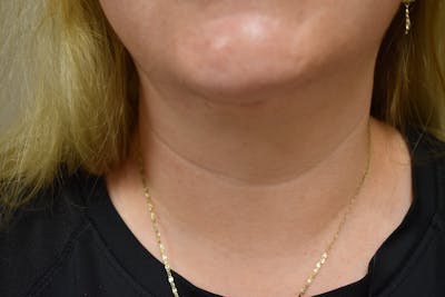 Neck Lift Before & After Gallery - Patient 414186 - Image 2