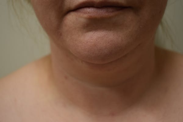 Neck Lift Before & After Gallery - Patient 414186 - Image 1
