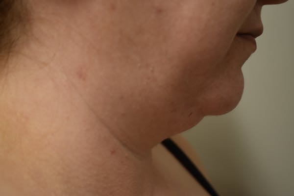 Neck Lift Before & After Gallery - Patient 414186 - Image 3
