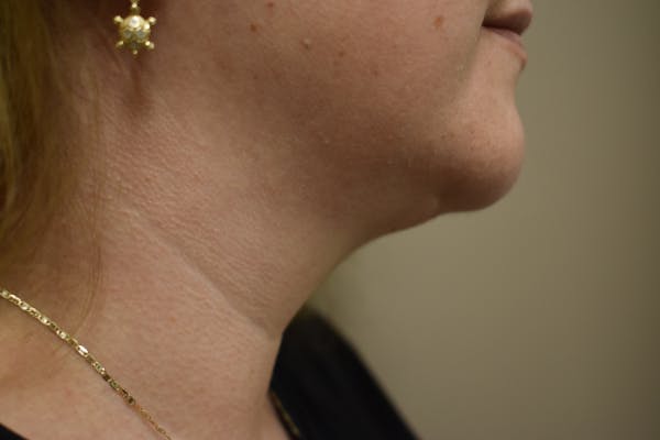 Neck Lift Before & After Gallery - Patient 414186 - Image 4