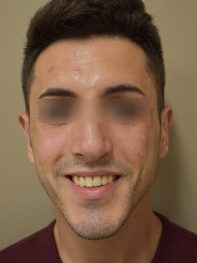 Otoplasty Before & After Gallery - Patient 129832 - Image 2