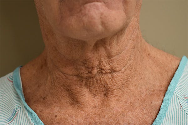Facelift Before & After Gallery - Patient 152876 - Image 3