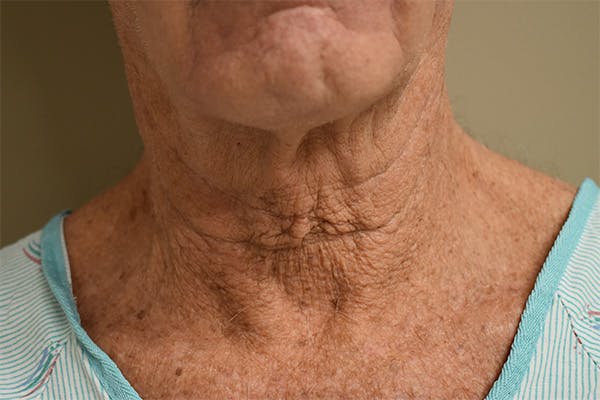Facelift Before & After Gallery - Patient 152876 - Image 3