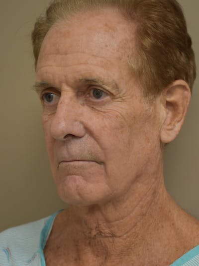 Facelift Before & After Gallery - Patient 152876 - Image 1