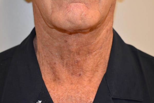 Facelift Before & After Gallery - Patient 152876 - Image 4