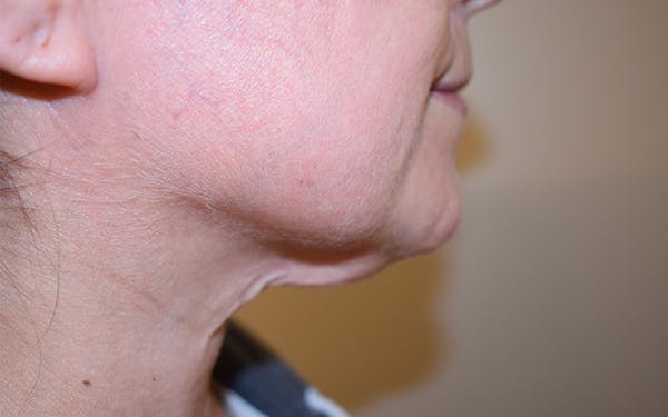 Chin Augmentation Before & After Gallery - Patient 292777 - Image 1