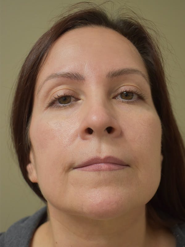 Chin Augmentation Before & After Gallery - Patient 292777 - Image 3
