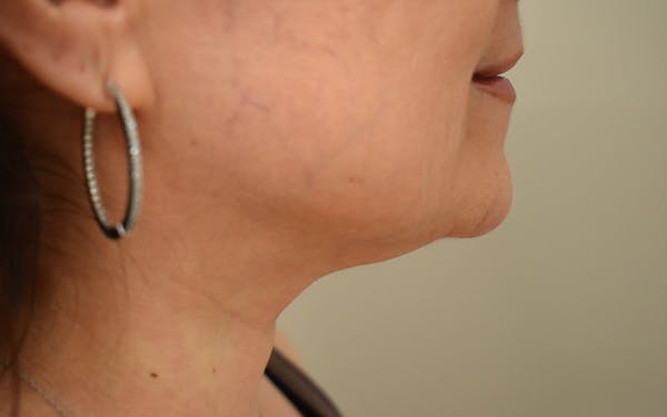 Chin Augmentation Before & After Gallery - Patient 292777 - Image 2