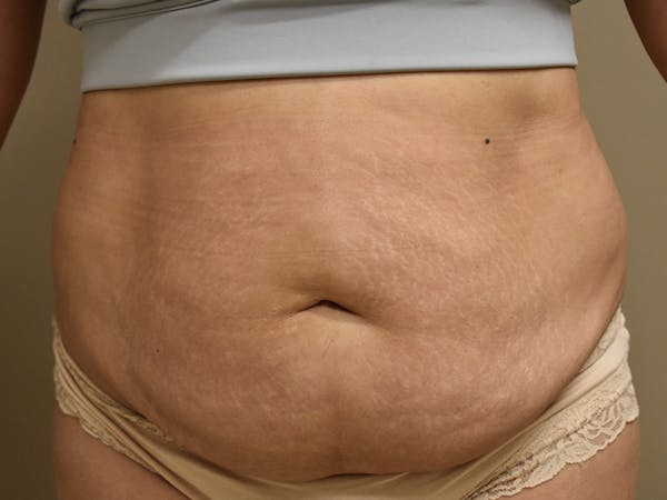 Tummy Tuck Before & After Gallery - Patient 234653 - Image 1