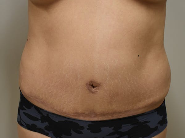 Tummy Tuck Before & After Gallery - Patient 234653 - Image 2