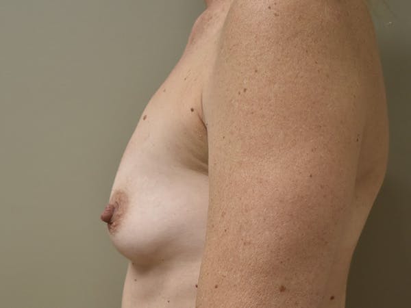 Breast Augmentation Before & After Gallery - Patient 247714 - Image 3