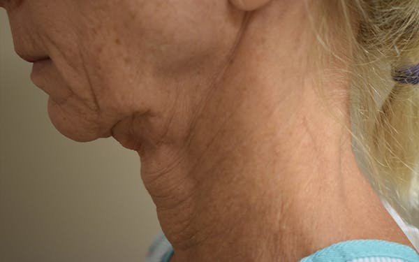 Facelift Before & After Gallery - Patient 306919 - Image 1