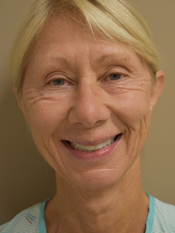 Facelift Before & After Gallery - Patient 306919 - Image 3